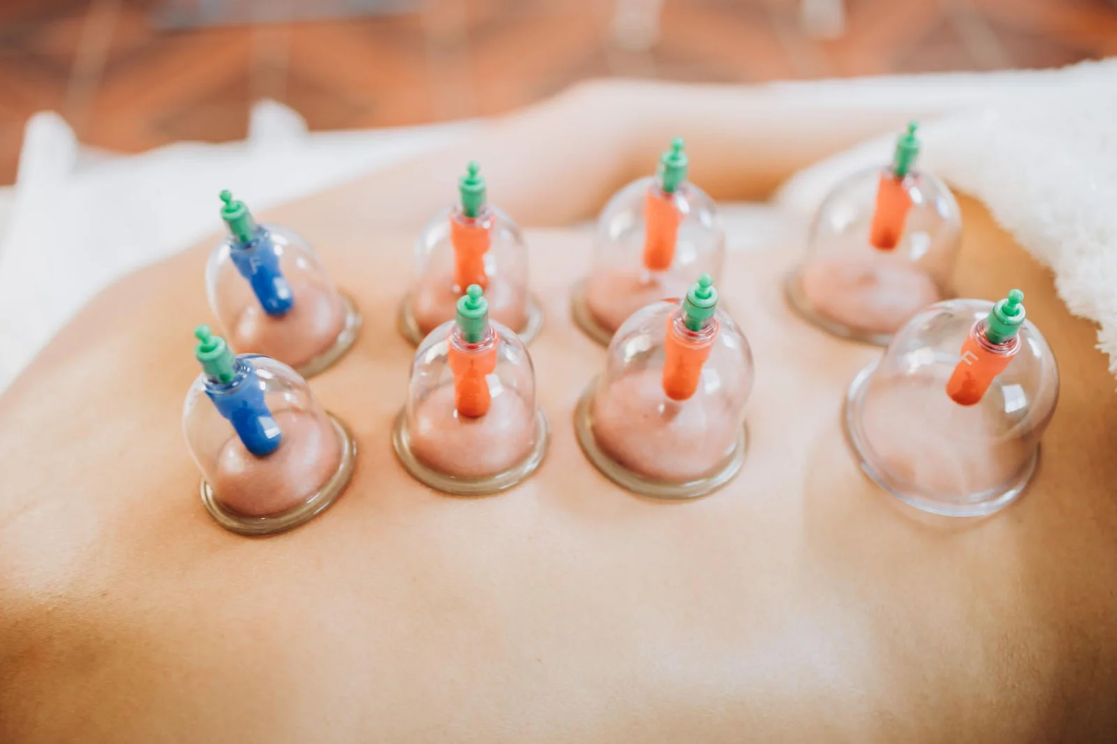 Cupping Therapy